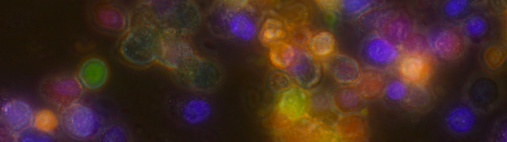 Fluorescent Tumour Cells