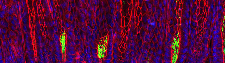 Magenschleimhaut mit Helicobacter pylori