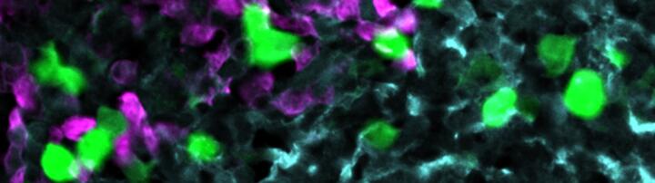 Anti-CXCR5 CAR-T cells (green) attack lymphoma cells (magenta) within the stroma cell network of the B cell follicle (light blue).