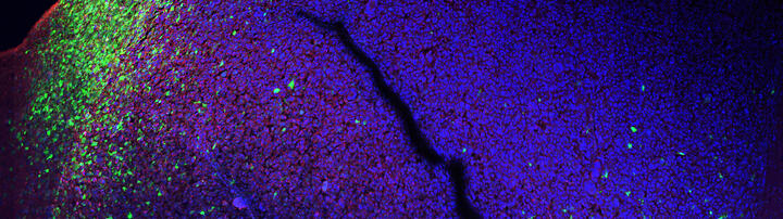 Fluorescence image of glioblastoma tissue using synthetic genetic tracing to visualize a mesenchymal cancer cell state in green, other cancer cell states in blue, and their spatial relationship with the tumor microenvironment. Credit @Gargiulo_lab