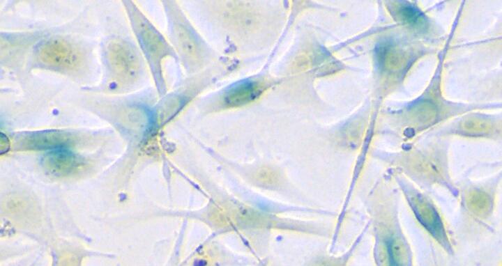 Melanoma cells under the microscope
