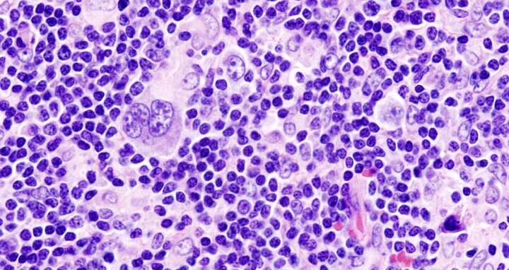 Histopathologic image of Hodgkin's lymphoma