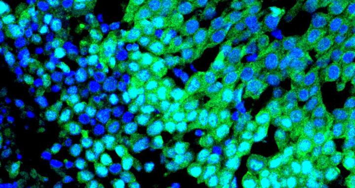 Immunofluorescence image of a basal breast tumour
