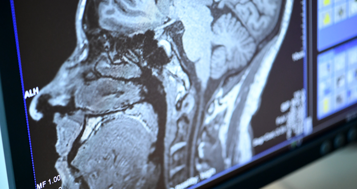 Sagittal slice of the brain