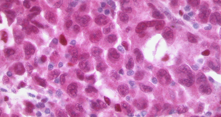 BATF3 in ALCL cells