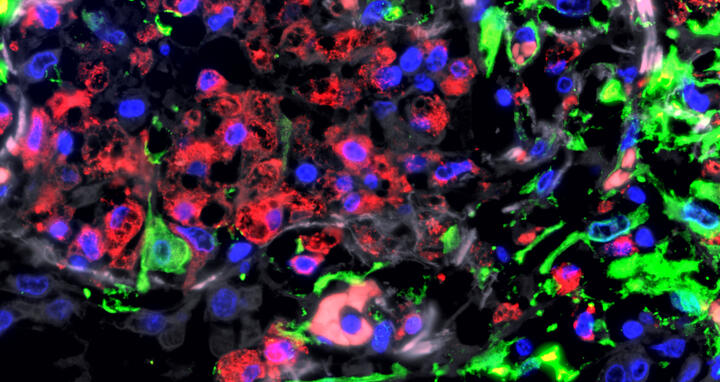 Immunofluorescence image of the lungs of a patient with severe COVID-19