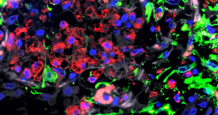 Immunfluoreszenz-Aufnahme der Lunge eines Patienten mit schwerem COVID-19