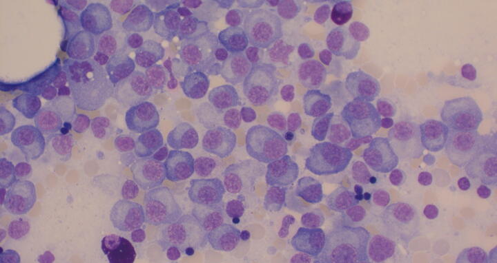 Microscope image of bone marrow with multiple myeloma cells
