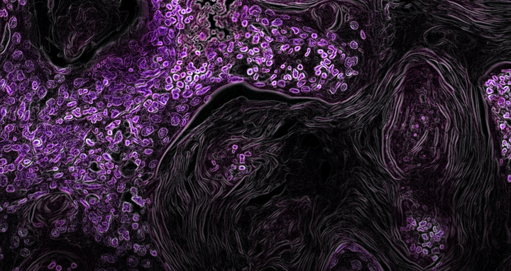 Kras-Driven Lung Cancer