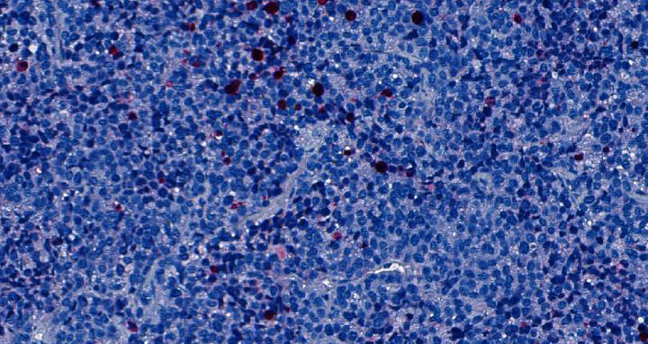 Tumorzellen eines Patienten mit Alveolarem Rhabdomyosarkom