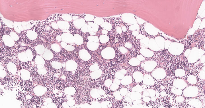 Microscopic image of a bone marrow biopsy