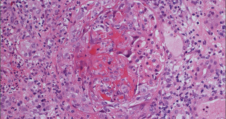 Scientific image of a stained tissue sample showing inflammation around a blood vessel.
