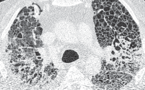 CT-Aufnahme einer Lunge mit COVID-19