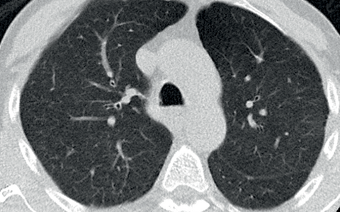 chest CT showing healthy lungs