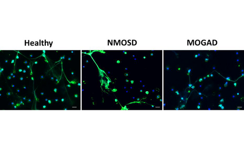 Images of neutrophils from healthy people, from AQP4-IgG seropositive NMOSD and MOGAD patients