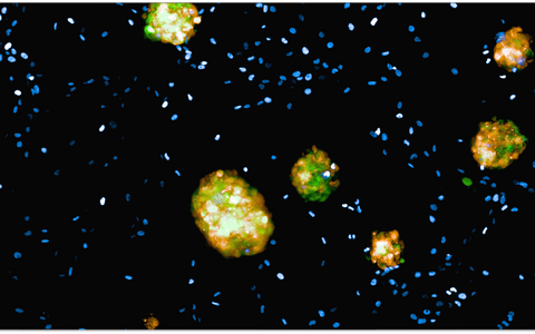Fluorescence image of glioblastoma tumoroids co-cultured with tumor-associated myeloid cells. Synthetic genetic tracing visualizes dynamic fluctuations between heterogeneous cancer cell states and how the tumor microenvironment influences cell identity. Credit: @Gargiulo_lab.