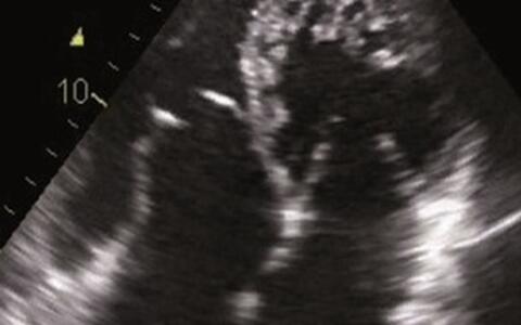 Echocardiography (4-chamber view) of a patient with Ebstein anomaly and LVNC