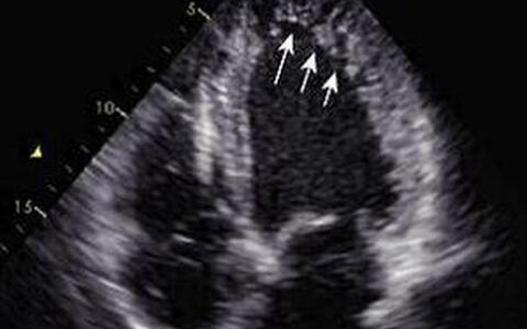 Fig. 2 Echocardiogram of a Patient with LVNC; arrows depict the noncompacted myocardium