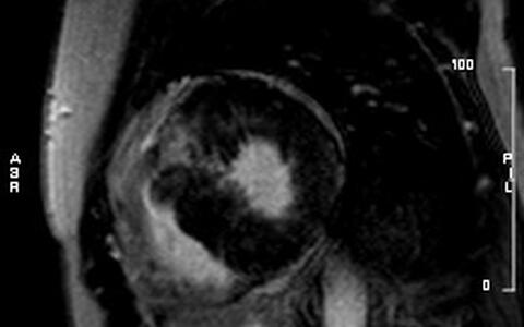 Herz mit hypertropher Kardiomyopathie mit Fibrose
