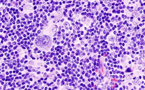 Histopathologic image of Hodgkin's lymphoma