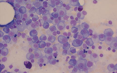 Microscope image of bone marrow with multiple myeloma cells