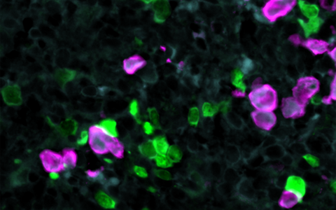 CAR-T cells attack tumor cells
