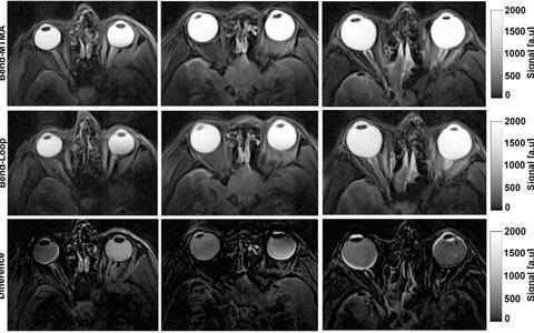 In vivo imaging T2-weighted MRI of three healthy volunteers (left to right columns) using the bend-MTMA and bend-loop antennas reveals increased intraocular signal for the metamaterial-based bend-MTMA configuration. (Courtesy: CC BY 4.0/Advanced Materials 10.1002/adma.202517760)