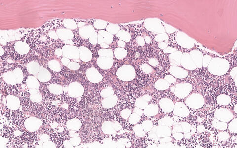 Microscopic image of a bone marrow biopsy