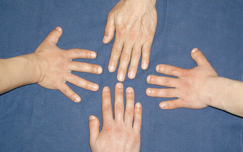 Different growth of fingers in one family. 
