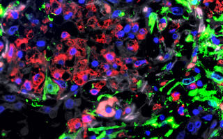 Immunofluorescence image of the lungs of a patient with severe COVID-19