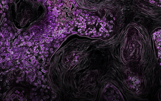 Kras-Driven Lung Cancer
