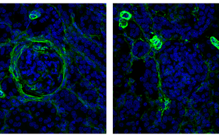 nephritis