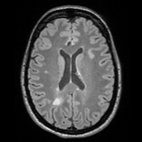 MRI scan of the brain