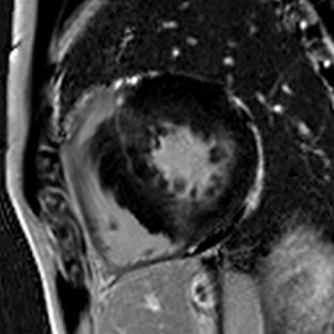 fibrotic tissue within the heart’s wall