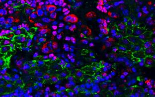 Colorful image of tumor cells with inhibited Ezh2