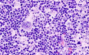 Histopathologic image of Hodgkin's lymphoma