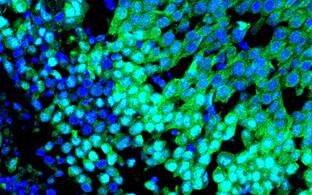 Immunfluoreszenzbild eines basalen Brusttumors