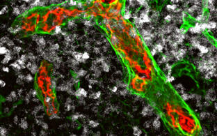 Hochendothelialen Venolen (im Bild rot-grün), können Immunzellen in die Lymphknoten einwandern und vorhandene Tumorzellen (weiß) zerstören