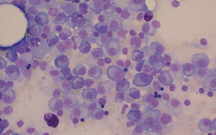 Multiple Myelom Zellen