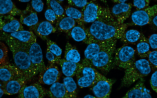Menschliche Zellen mit einer krankheitsauslösenden RBM20-Mutante