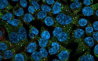 Human cells with a disease-causing RBM20 mutant