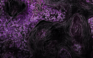 Kras-Driven Lung Cancer