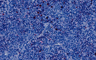 Tumorzellen eines Patienten mit Alveolarem Rhabdomyosarkom