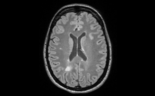 MRT-Bild eines Gehirns