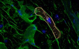 Hypertrophic Cardiomyopathy 