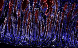 Stomach tissue infected with Helicobacter pylori