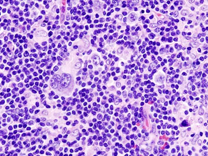 Histopathologic image of Hodgkin's lymphoma