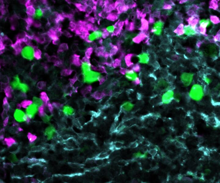 Anti-CXCR5 CAR-T cells (green) attack lymphoma cells (magenta) within the stroma cell network of the B cell follicle (light blue). 