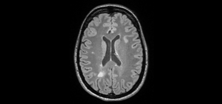 MRI scan of the brain