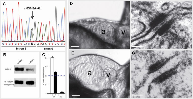 Arrhythmogenic Right Ventricular Cardiomyopathy (ARVC) | Max Delbrück ...